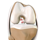 ACL Tears/Ruptures