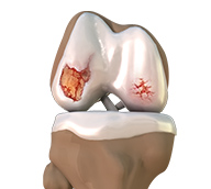 Cartilage Defects/Osteochondral Defects
