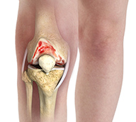 Knee Arthritis