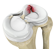 Knee Meniscal Tears