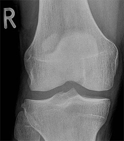 Knee Xray