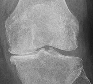 Knee Xray